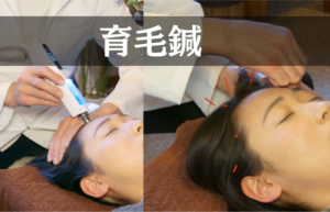 育毛鍼